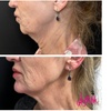 Image 3: PDO Thread Lift Treatment for Cheek & Jowl w/ Optional Neck & Jawline