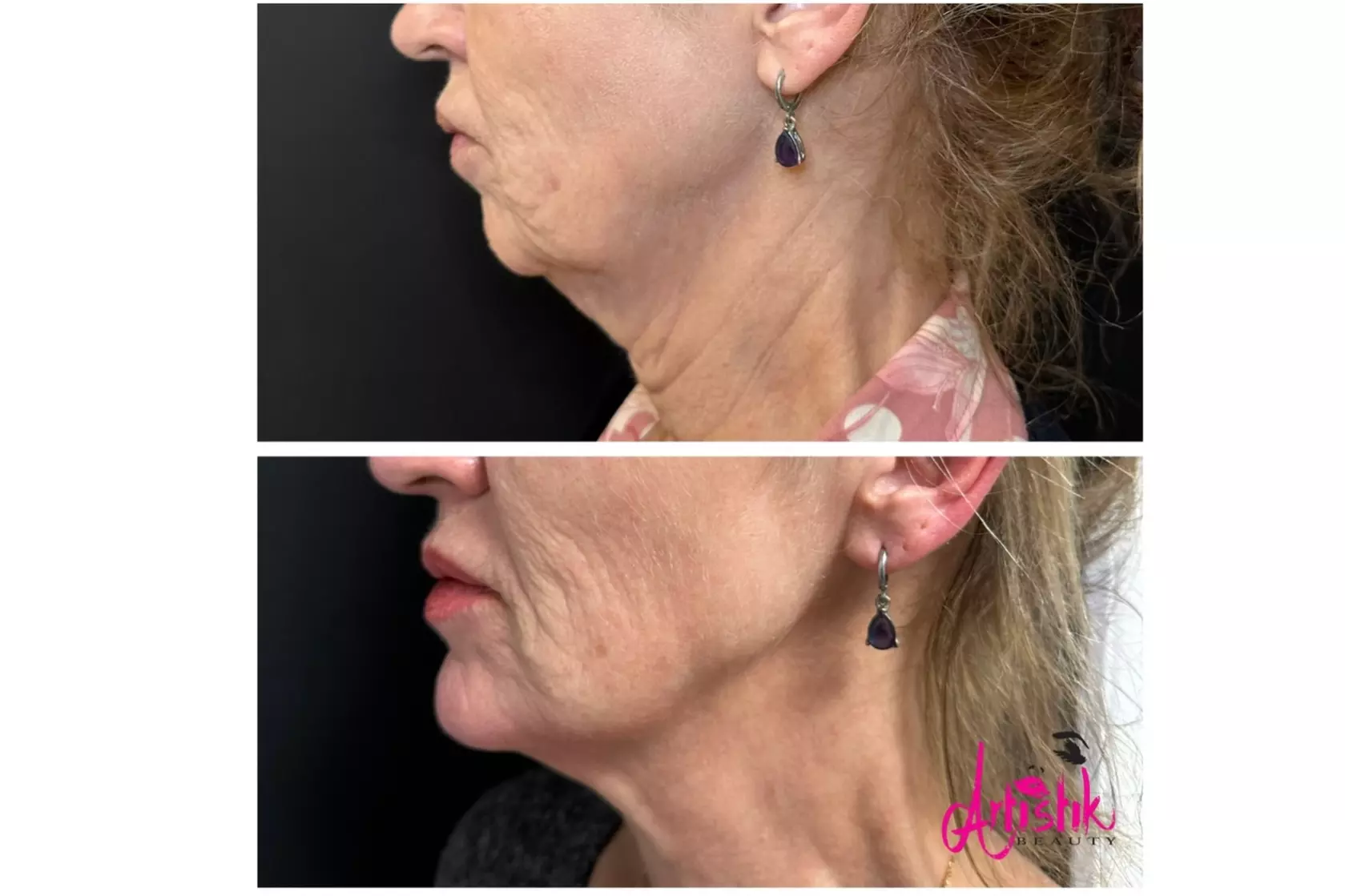 PDO Thread Lift Treatment for Cheek & Jowl w/ Optional Neck & Jawline