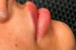Natürlich volle Lippen: 45 Min. Lippen-Auffüllung mit bis 0,5 ml Hyaluronsäure für 1 Person (52% sparen) - Image 2