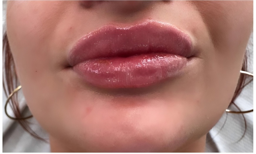 Image 2: Lip Filler Treatment at Paradise Aesthetics and Nutrition Clinic