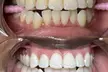 Up to 30% Off on Teeth Whitening at Grin & Glow - Second Medium