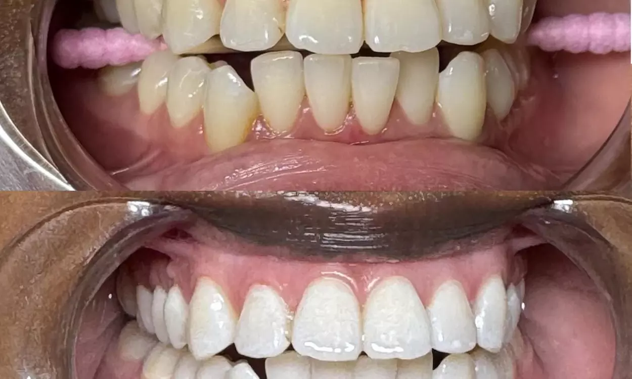 Teeth Whitening Sessions in 30–90 Min or Couples 60–90 Min Options