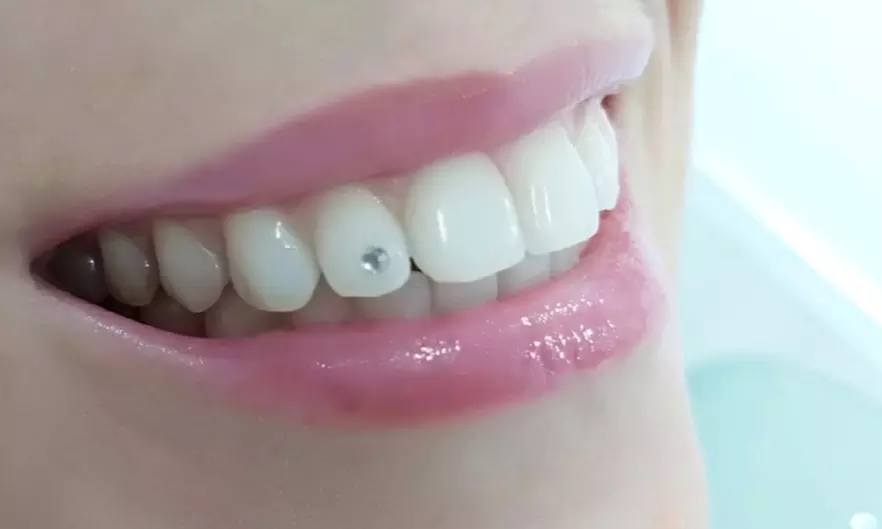Limpieza dental con ultrasonidos en la clínica Ara Dental