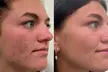 Choice of Amore Classic Facial, Microdermabrasion, Dermaplaning, or Microneedling Treatment (Up To 45% Off) - Second Medium