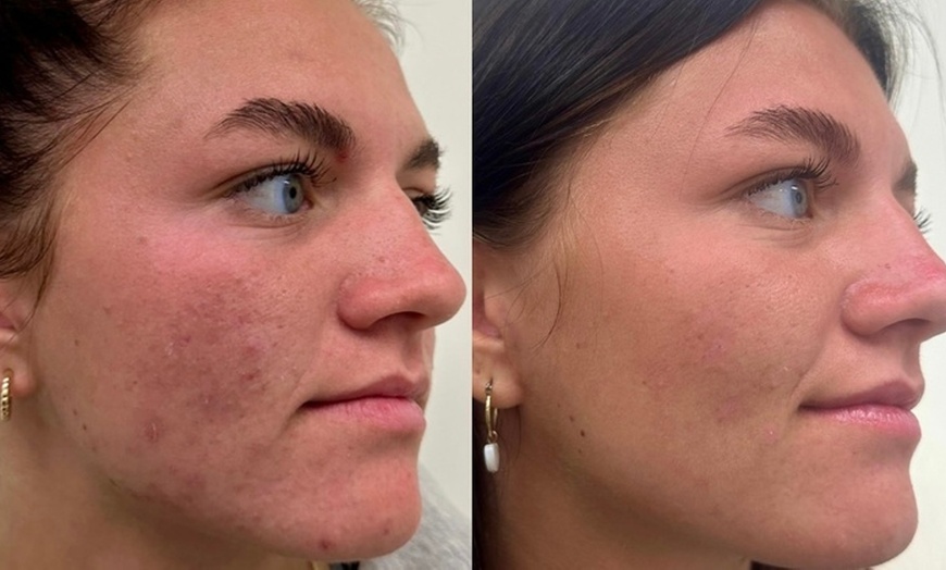 Image 2: Choice of Facial- Classic, Microdermabrasion, or More 