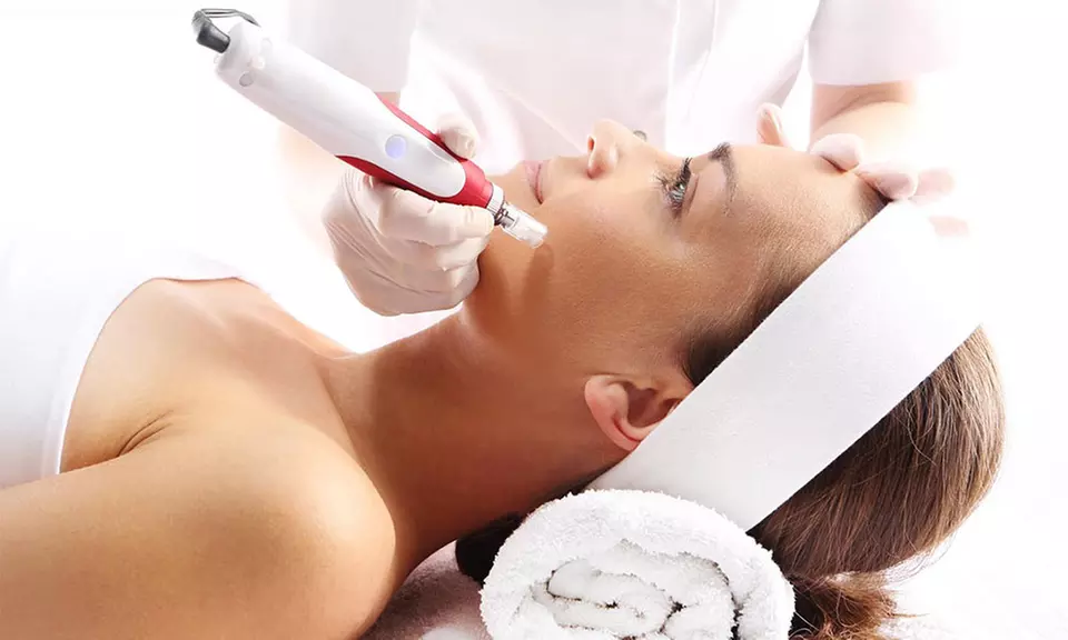 1x oder 2x Microneedling mit Hyaluron im Zentrum für apparative Kosmetik Terma (bis zu 57% sparen*) - Primary Image