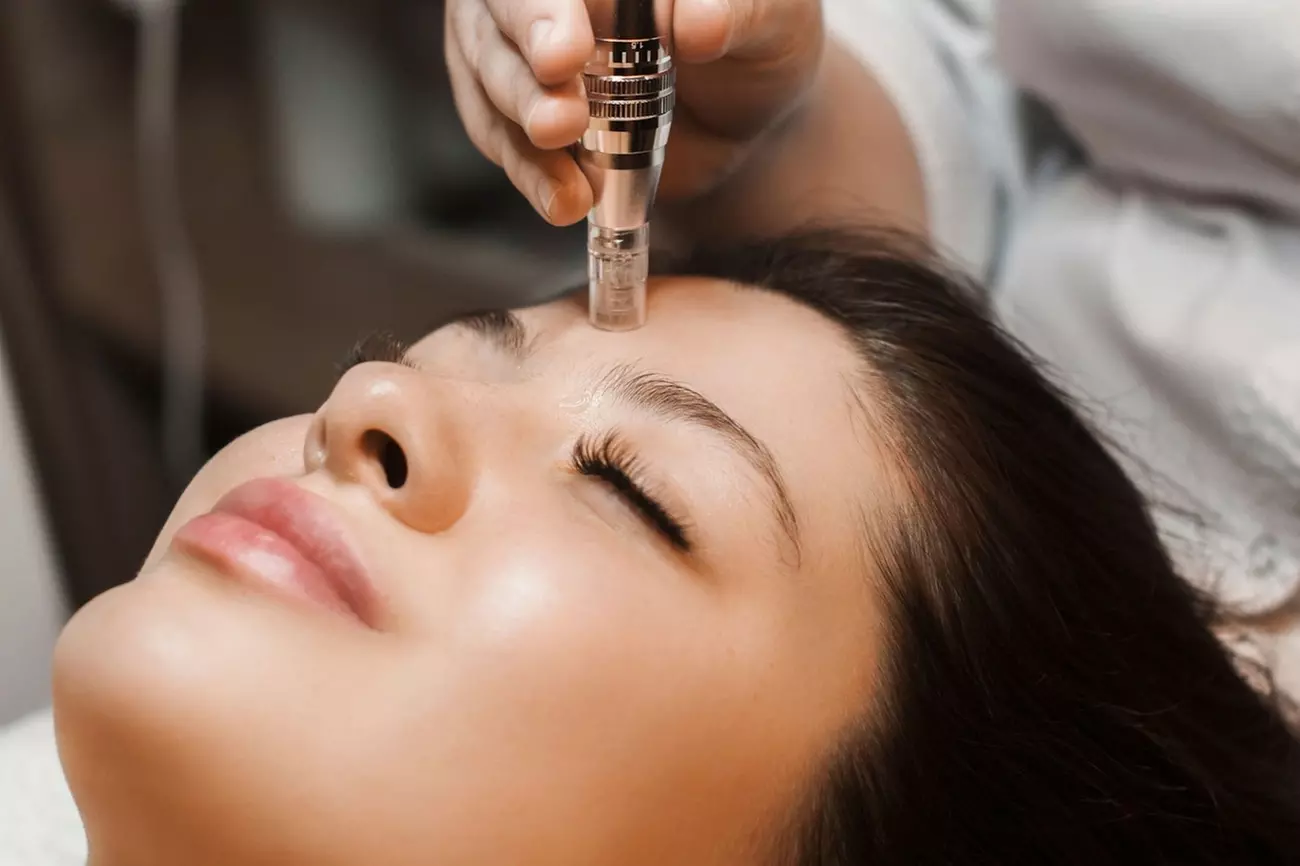 Microneedling Treatment at JA Beauty Med Spa (Up to 40% Off) - Primary Image