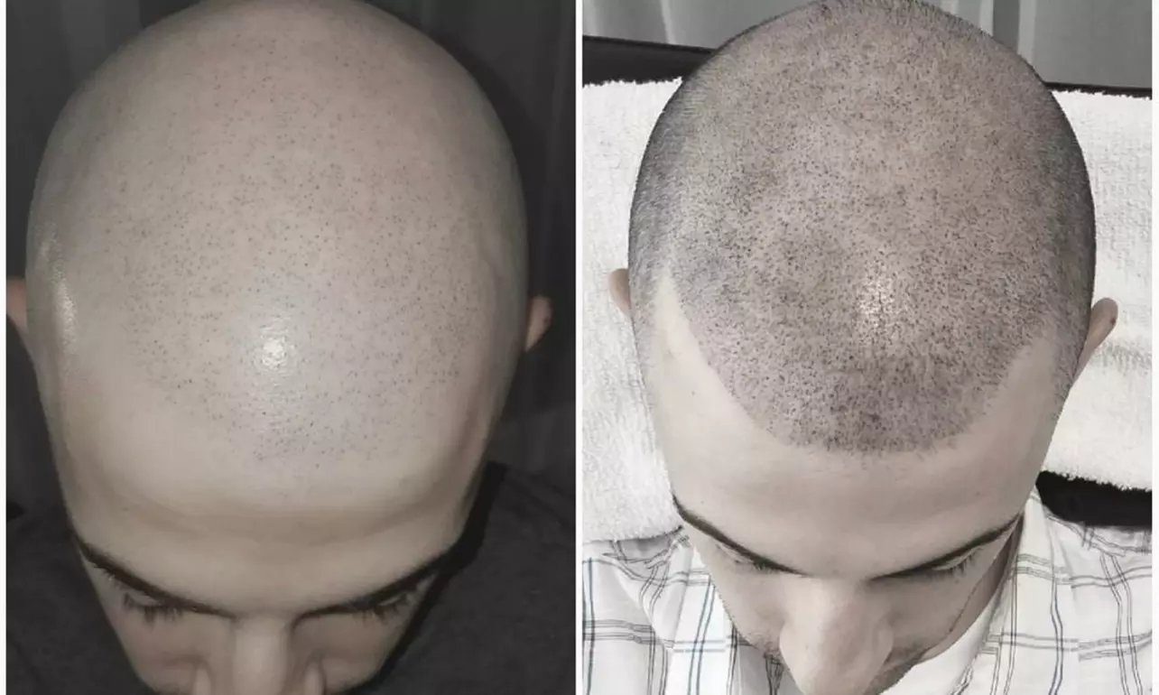 Experience Scalp Micropigmentation for a Fuller Hair Look