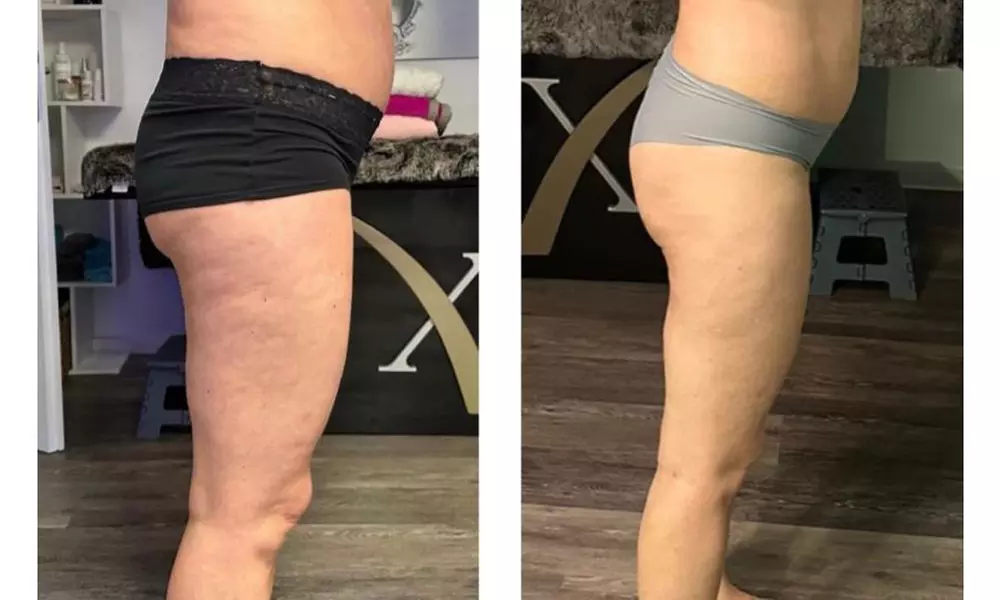 Bis 12 Slimstar-Pads-Behandlungen an 1-3 Zonen zur Wahl für 1 Person