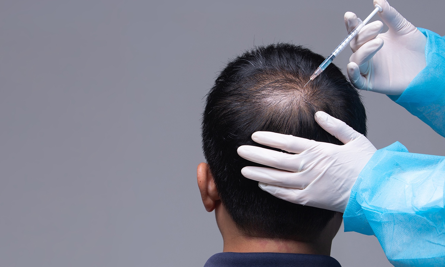 Boost Confidence: PRP or i-PRF Hair Treatment