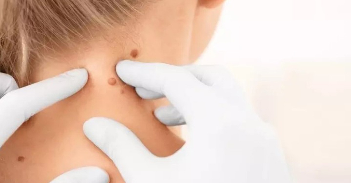 Servicio estético con plasma pen para lunares y bultos en Madrid
