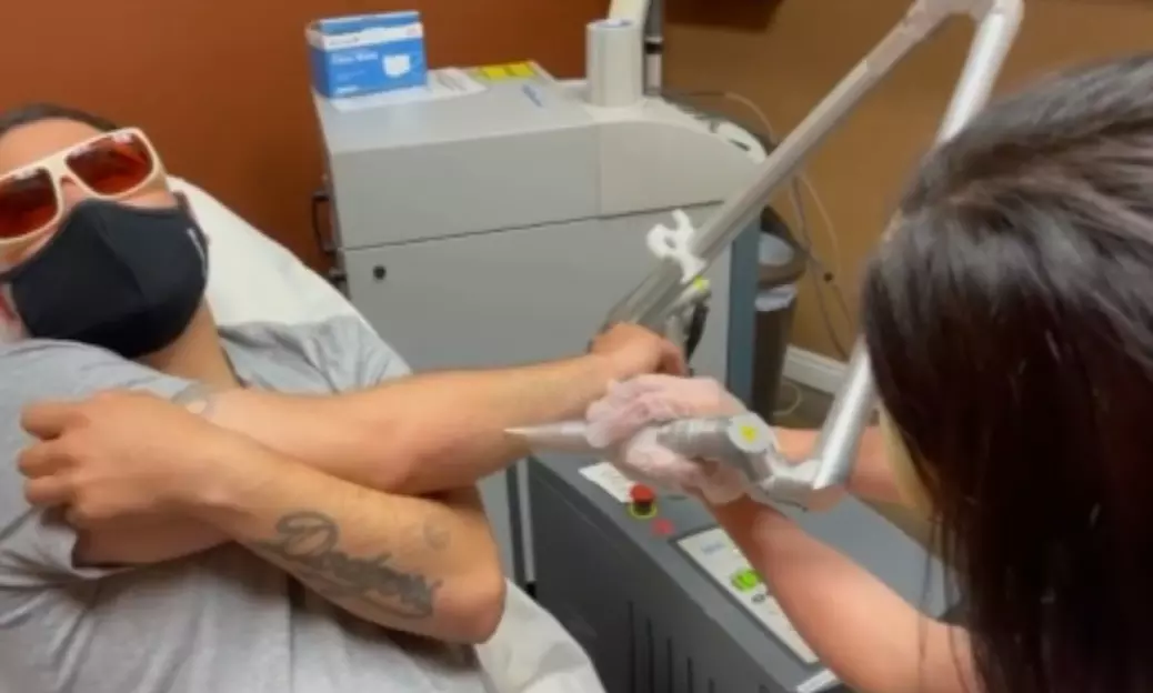 Laser Tattoo Removal Session Options for Different Area Sizes
