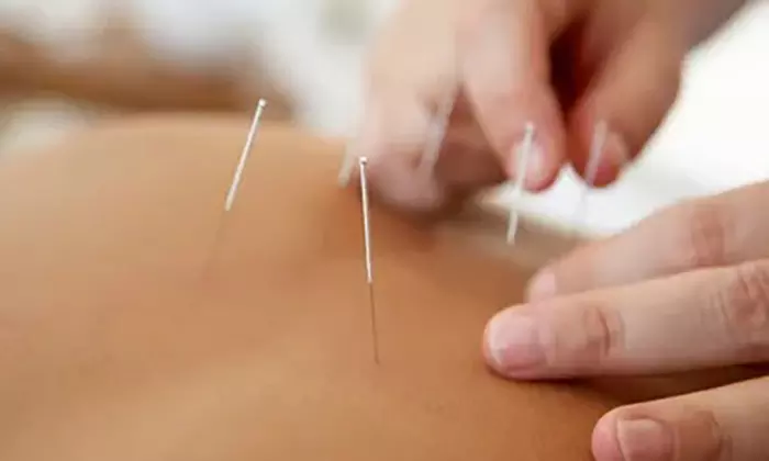 Find Relief with One/Two Acupuncture Sessions w/ Initial Consult at Good Day Total Health Clinic(Up to 57% Off) - Primary Image