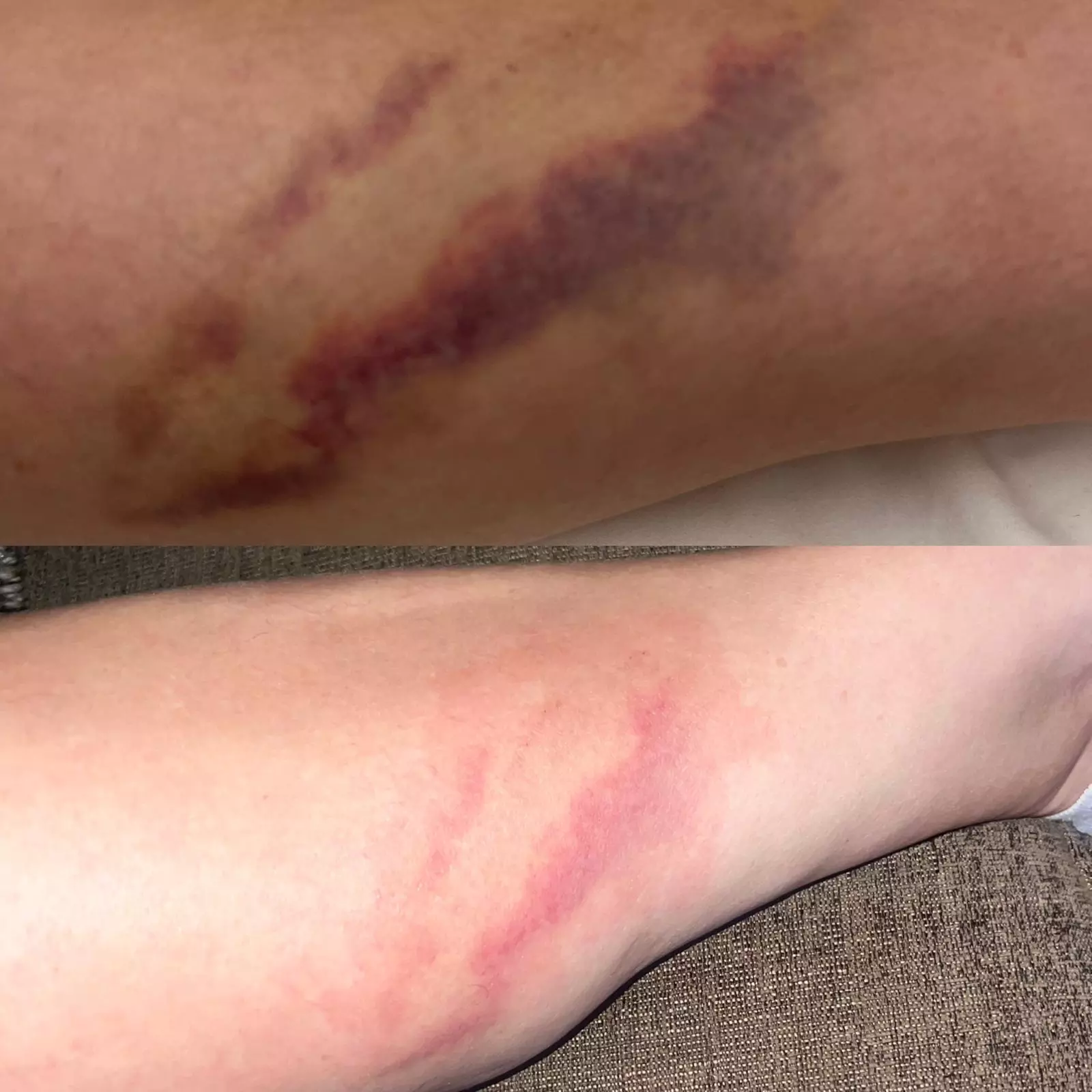 One or Two Laser Skin Resurfacing Treatments