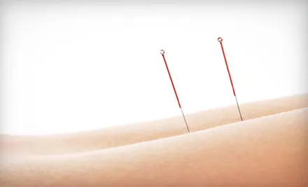 Consultation with One, Two, or Three Acupuncture Sessions at Focus For Life Naturopathic Scottsdale (Up to 81% Off) - Primary Image