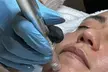 Klassische Gesichtsbehandlung,  Aqua-Facial-Tiefenreinigung und/oder kosmetisches Microneedling (bis 35% sparen) - Second Medium