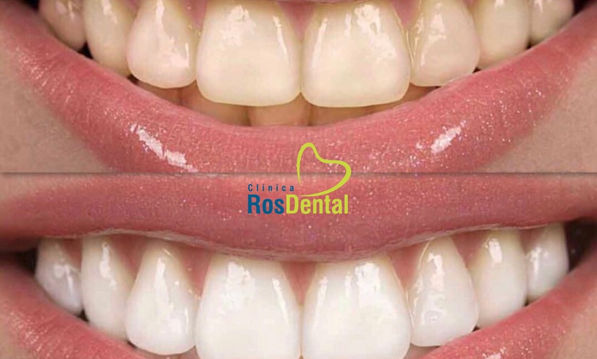 Image 6: Blanqueamiento dental led