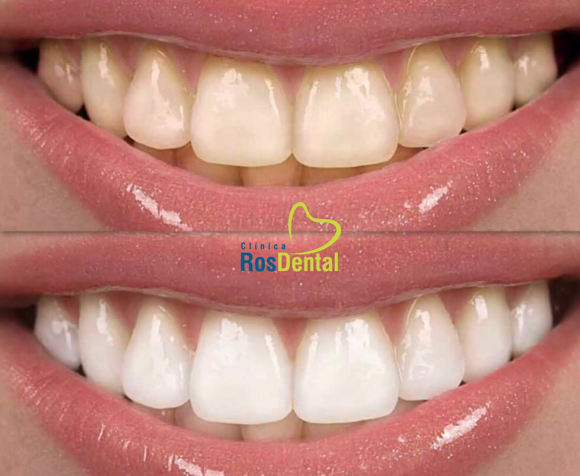 Blanqueamiento dental led