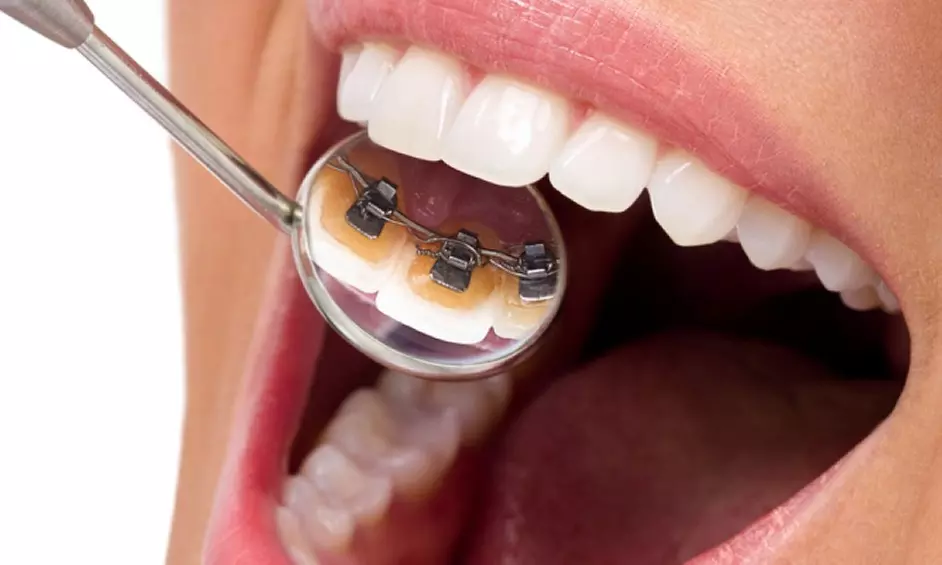 Lingual Braces for One or Two Arches at Dental Care London - Primary Image