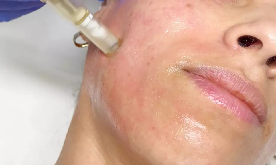 Transform Your Skin's Texture and Tone with Micro-Needling