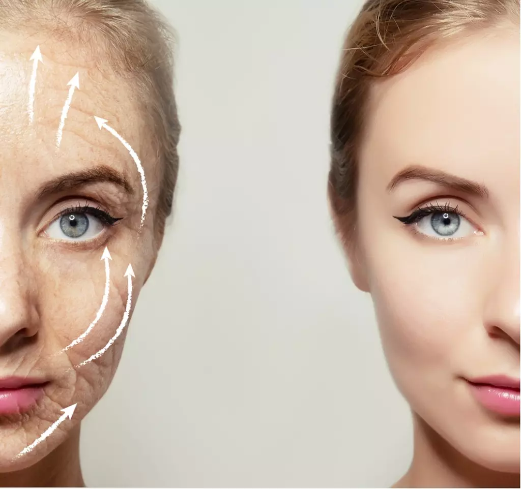 Botox- Dysport