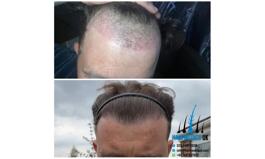 Image 9: Natural-Looking Hair Restoration with Up to 3000-Graft FUE Transplant