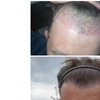 Image 9: Natural-Looking Hair Restoration with Up to 3000-Graft FUE Transplant