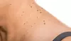 Up to 89% Off on Mole / Growth Removal at Glow Boss Institute MedSpa