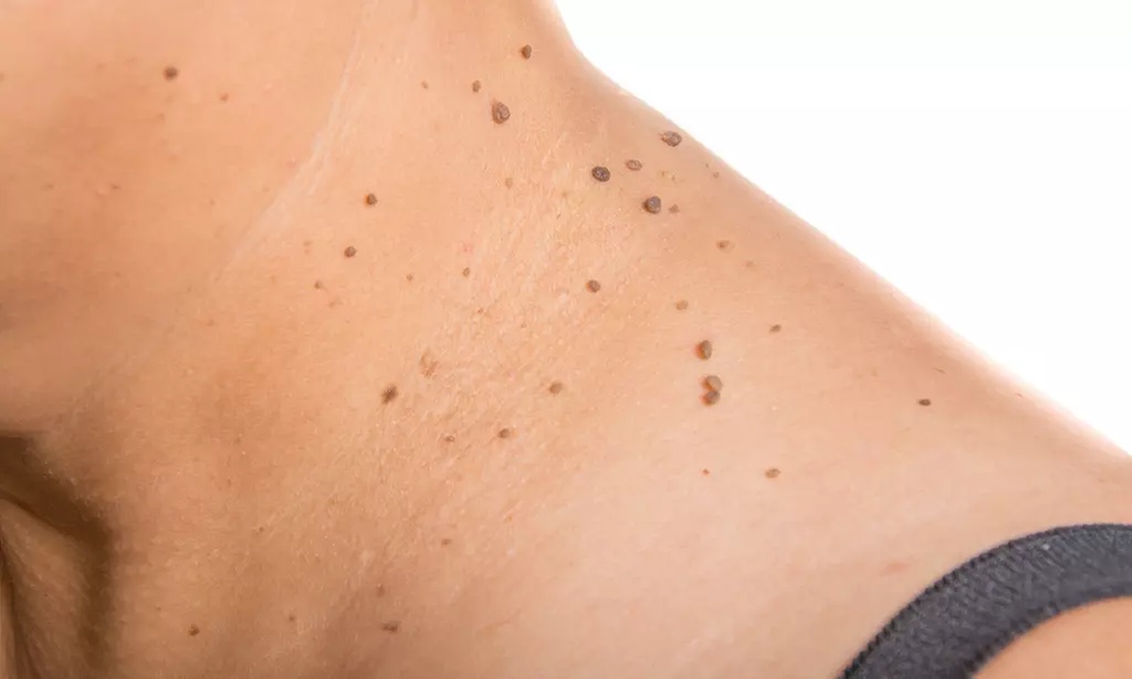 Mole / Growth Removal at Glow Boss Institute