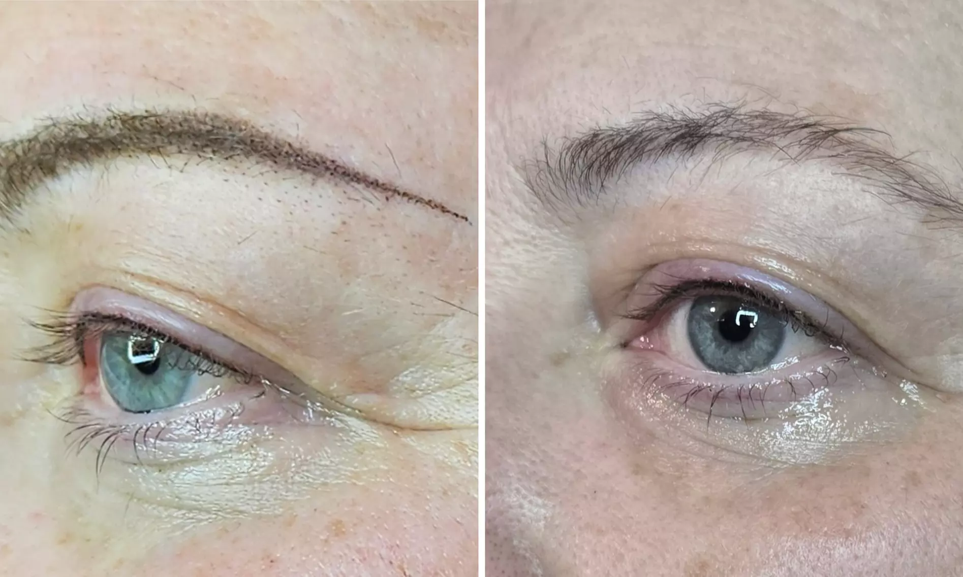 45 Min. Carbon Laser Peeling oder IPL Behandlung nach Wahl für 1 Pers.