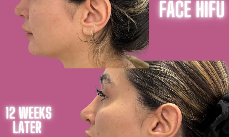 Image 4: Revitalize with HIFU Face Treatment for Face with/without Neck