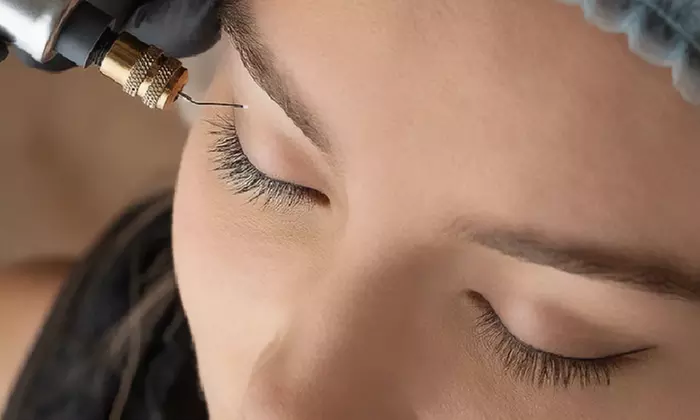 Choose One or Two Sessions: Plasma Pen Fibroblast for Eyes or Any Area