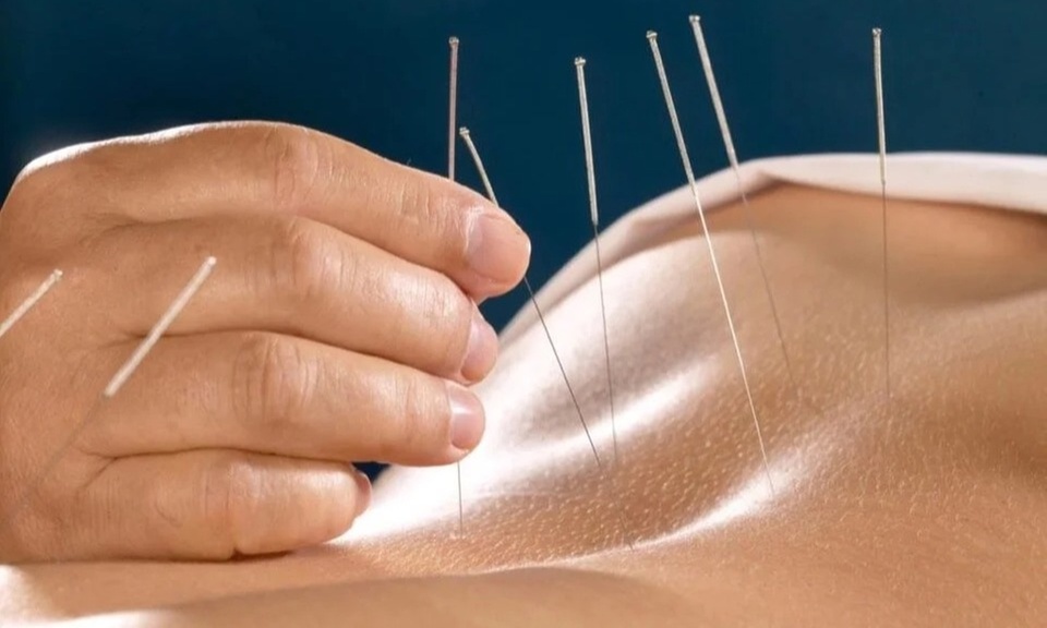 Holistic Acupuncture Therapy by Expert TCM Practitioners