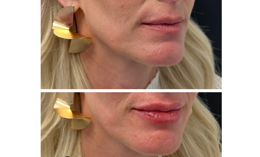 Image 8: Enhance Beauty with 1.5 CC Radiesse or 1.0 CC Hyaluronic Acid Filler