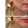 Image 8: Enhance Beauty with 1.5 CC Radiesse or 1.0 CC Hyaluronic Acid Filler
