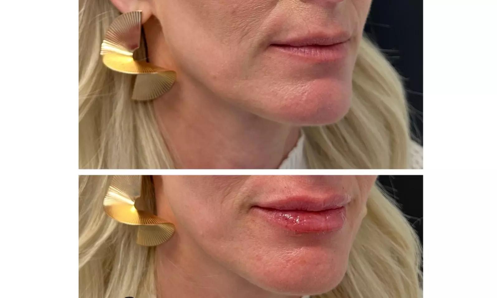 Enhance Beauty with 1.5 CC Radiesse or 1.0 CC Hyaluronic Acid Filler