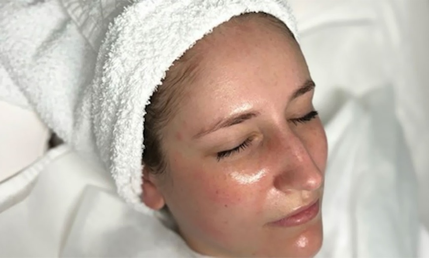 Image 2: Aqua-Facial und/oder kosmetisches Microneedling für 1 Pers.