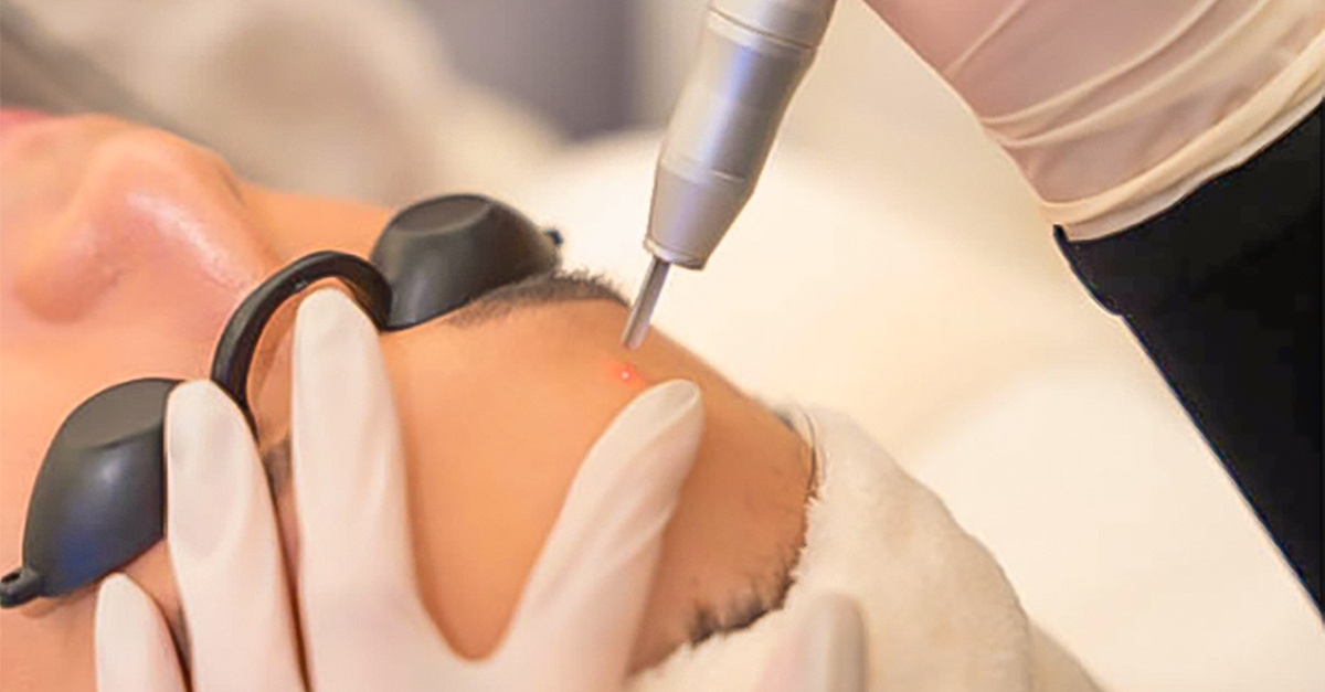 Servicio de eliminación de tatuajes de micropigmentación en Las Palmas