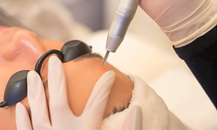 Eliminación de tatuajes micropigmentación  en 1 o 2 sesiones