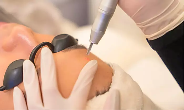 Eliminación de tatuajes micropigmentación  en 1 o 2 sesiones