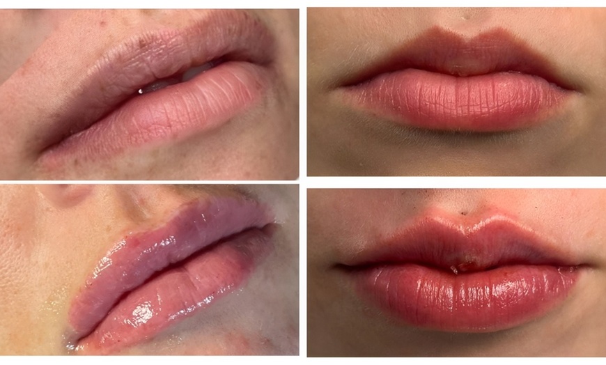 Image 1: 1ml or 2ml Dermal Filler Treatment on Lips with Consultation