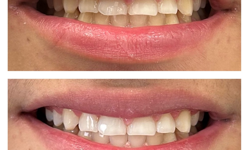 Image 2: Get a Brighter Smile with Phillips Zoom Whitening! Teeth Whitening