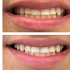 Image 2: Get a Brighter Smile with Phillips Zoom Whitening! Teeth Whitening