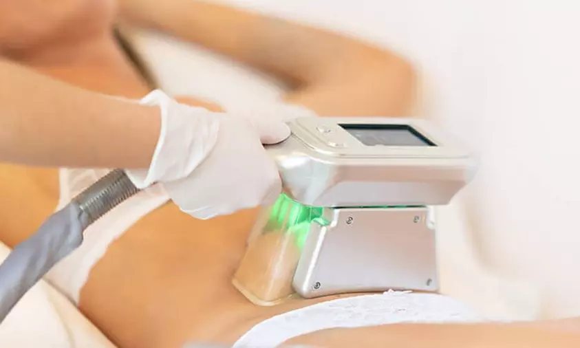 Séance de cryolipolyse "perte de cm par le froid"