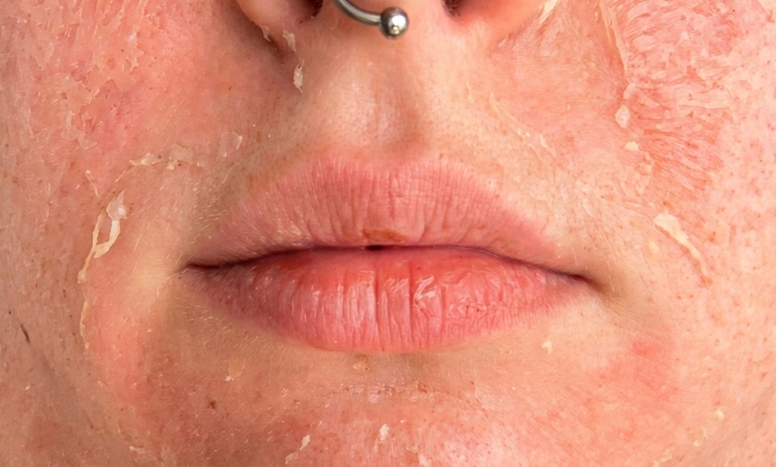 Image 7: One, Two, Three or Four Professional Grade Pro Chemical Peels