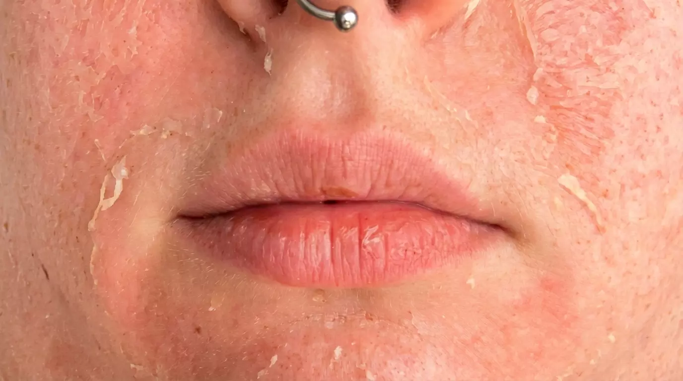 One, Two, Three or Four Professional Grade Pro Chemical Peels