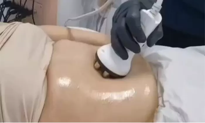 HIFU Treatment on Full Face with Optional Neck or Body