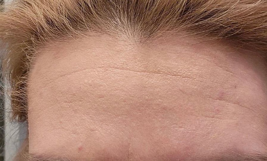 Image 2: Lift and Rejuvenate with HIFU Face, Neck, Chin Lift and More!