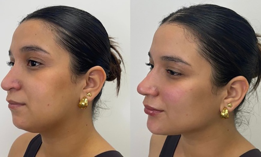 Image 2: 1 o 3 sesiones de mesoterapia facial inyectada