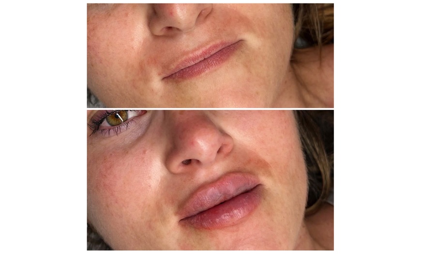 Image 5: Revitalize with 0.5 ml or 1 ml Revolax Derma Filler with Consultation